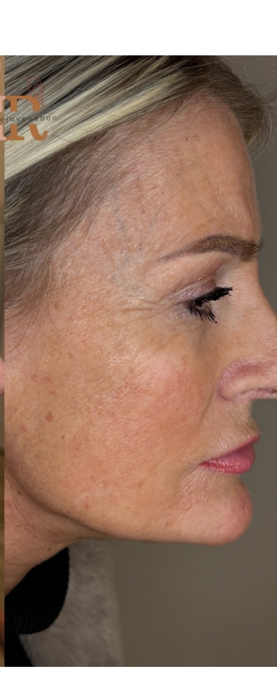 Facial volume restoration after