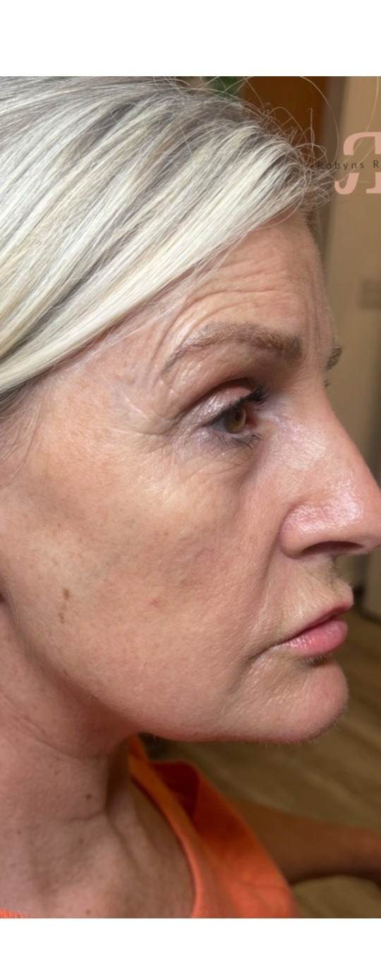 Facial volume restoration before