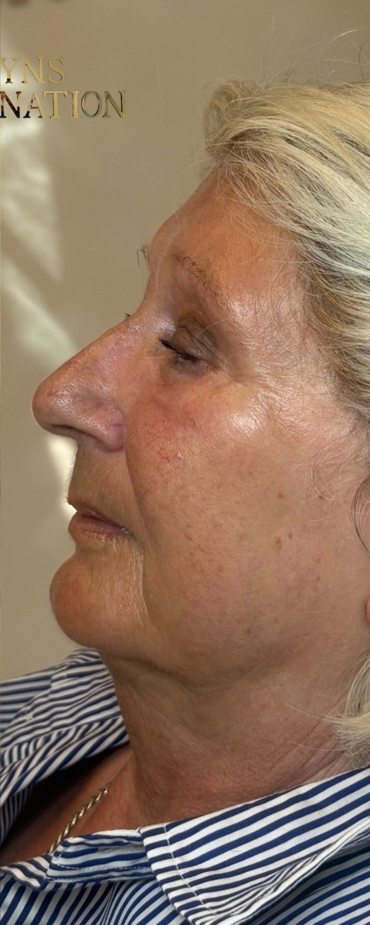 Profile rejuvenation after