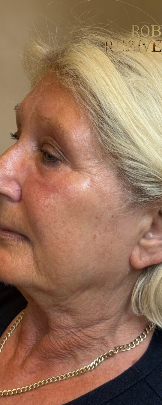 Profile rejuvenation before